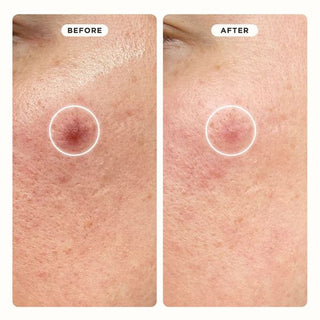 Los Ireneda Pimple Patvh ayudan a eliminar las imperfecciones, así como a reparar la piel de marcas o manchas ocasionadas por el acné. Disponible en Shirakaba Beauty