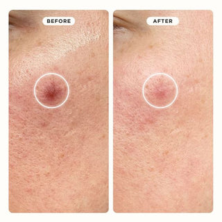 Los Ireneda Pimple Patvh ayudan a eliminar las imperfecciones, así como a reparar la piel de marcas o manchas ocasionadas por el acné. Disponible en Shirakaba Beauty